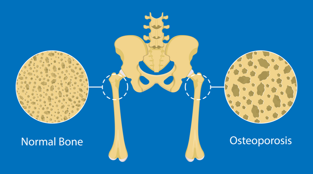 osteoporosis.